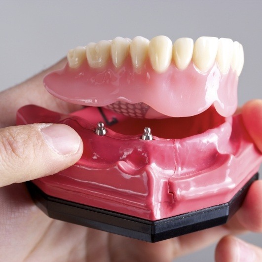 mini dental implant model