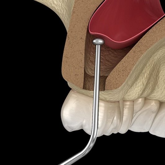 Illustration of sinus lift procedure against dark background