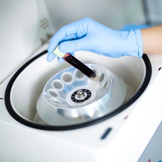Placing blood in centrifuge in preparation of PRF/PRP treatment