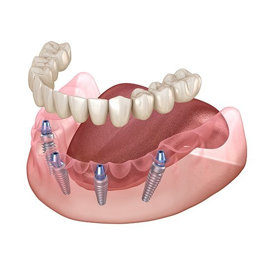 Animated all on four dental implant denture placement