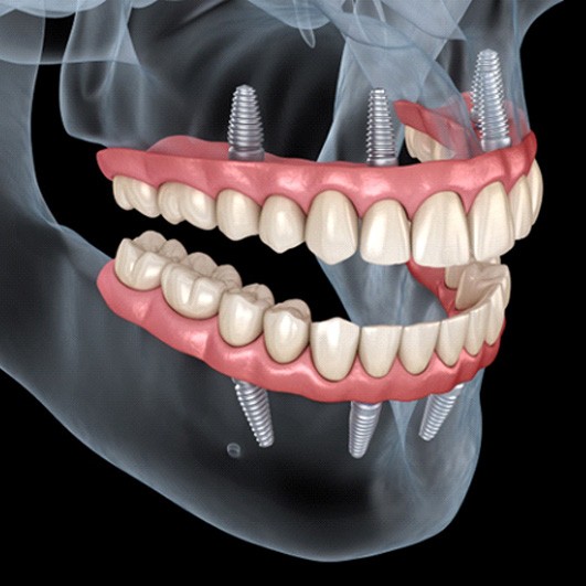Illustration of All-on-4 dental implants in upper and lower dental arches