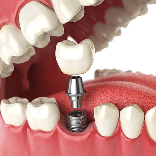 Animated  dental implant supported dental crown placement