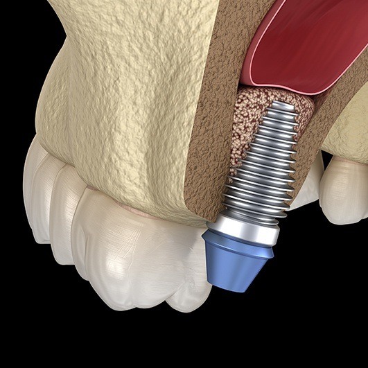 Animated dental implant post placed into a bone graft