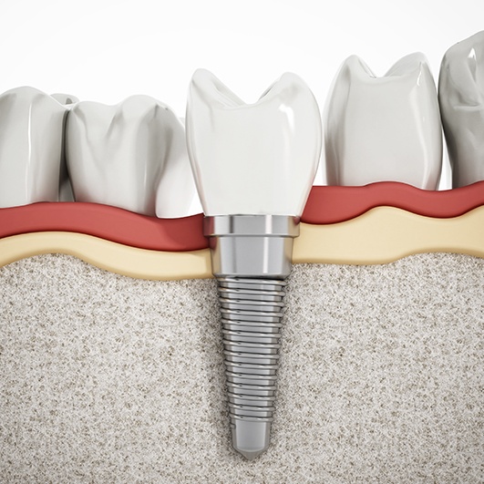 Animated smile with dental implant replacement tooth after bone grafting procedure