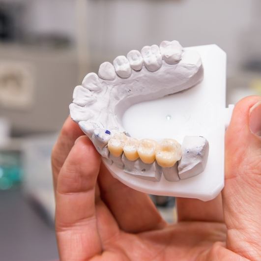 dental implant bridges model