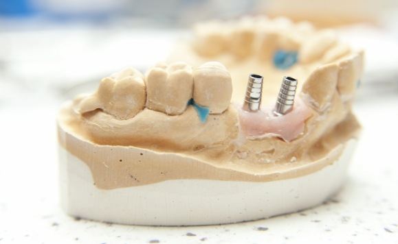 Model smile with two dental implant posts visible