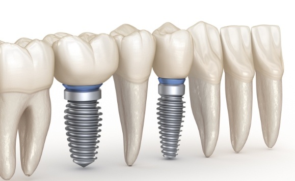 Animated smile withtwo dental implant supported dental crowns