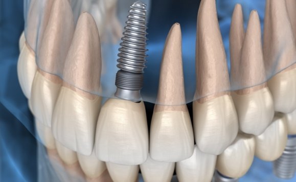 Animated smile with dental implant supported dental crown on top arch
