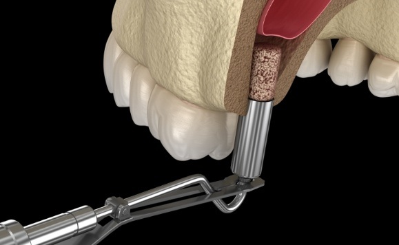 Animated bone grafting procedure