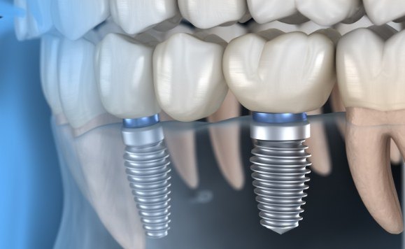 Animated smile with a one stage and two stage dental implant visible in smile line