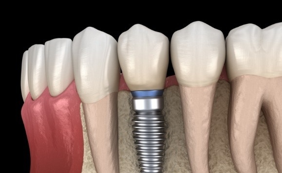 Animated smile with dental implant supported dental crown