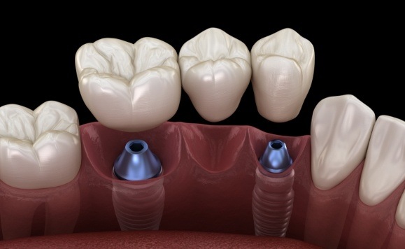 Animated dental implant supported fixed bridge placement