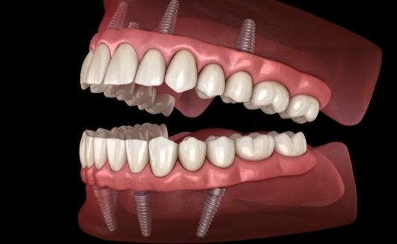 Animated smile with dental implant supported top and bottom dentures