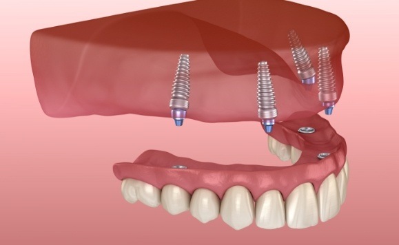 Animated dental implant denture placement