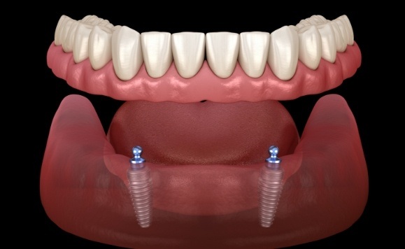 Animated all on four dental implant denture placement