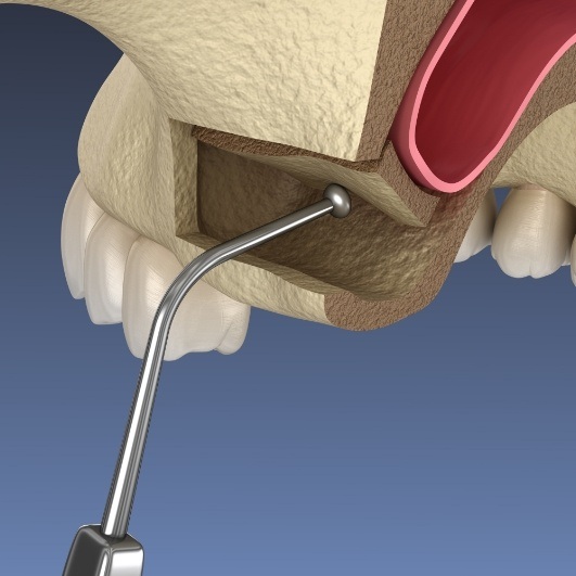 Animated sinus lift procedure