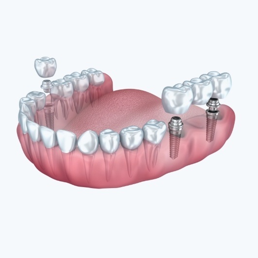 Animated dental implant supported multiple tooth replacement