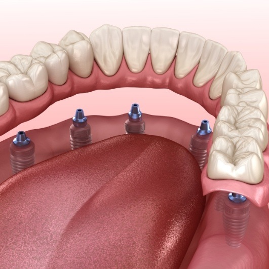 Animated all on six dental implant denture placement