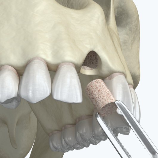 Animated bone grafting