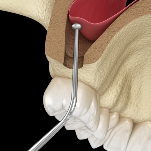 Animated sinus lift procedure