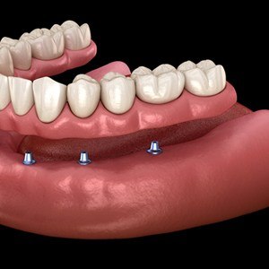 Illustration of implant denture for lower arch against dark background