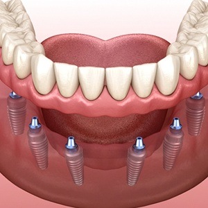 Illustration of implant dentures supported by six dental implants