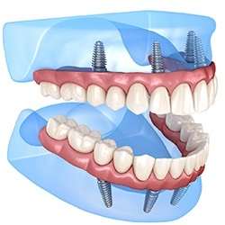 Illustration of implant dentures for upper and lower arches