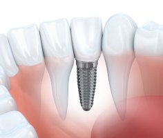 Animated dental implant supported dental crown