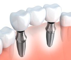 Animated dental implant supported fixed bridge