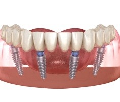 Animated dental implant supported denture