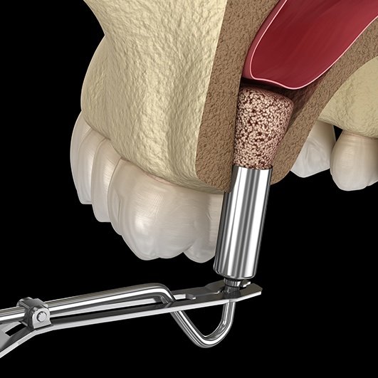 Animated jaw with bone tissue graft