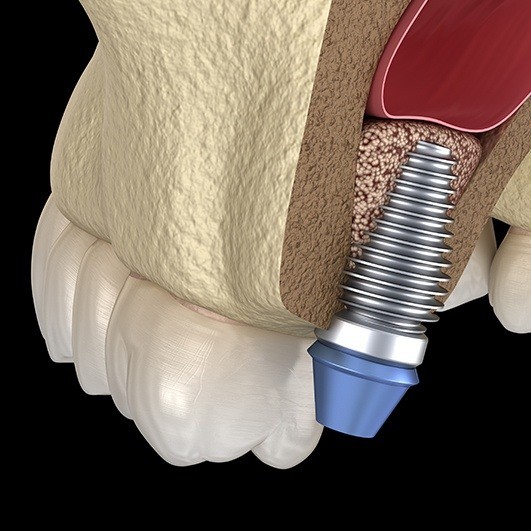 Animated dental implant  post with abutment in place