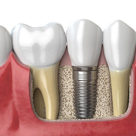 Animated dental implant supported replacement tooth