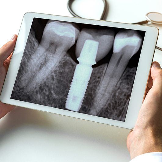 X-ray of dental implant supported replacement tooth