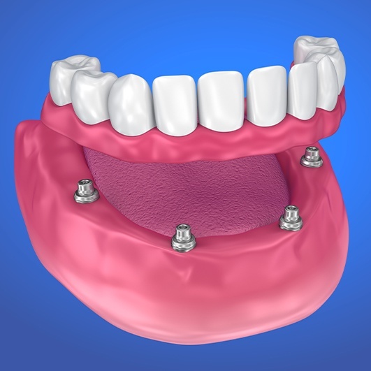 Animated dental implant supported denture placement