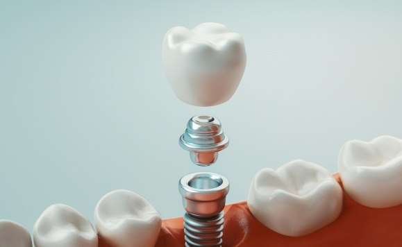 Animated dental implant supported dental crown placement