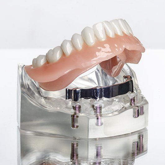 Model dental implant supported denture