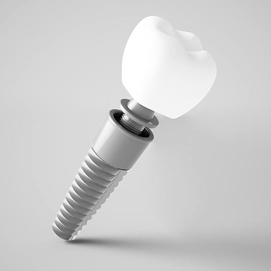 Animated parts of a dental implant supported dental crown