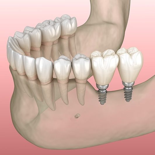 Animated mini dental implant dental bridge restoration