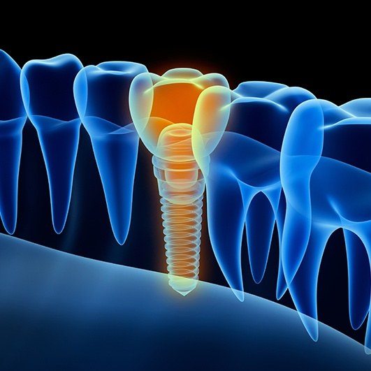 3 D rendering of smile with dental implant supported replacement tooth