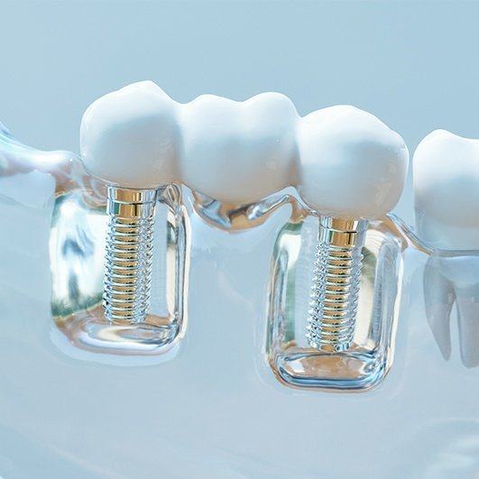 Model dental implant supported fixed bridge