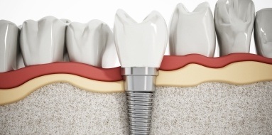 Animated dental implant supported dental crown