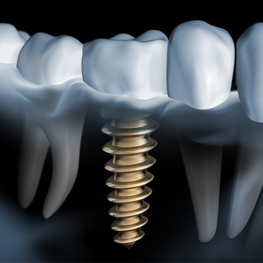 Animated dental implant supported dental crown in smile line