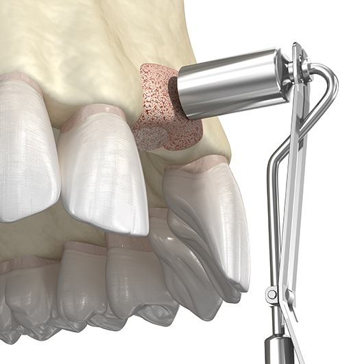 Animated bone grafting procedure