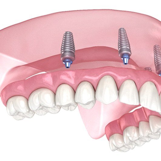 Illustration of Teeth in a Day against white background