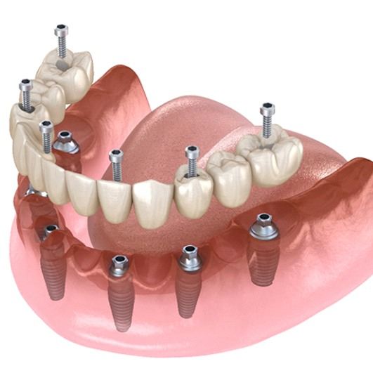 Arch of prosthetic teeth supported by six dental implants