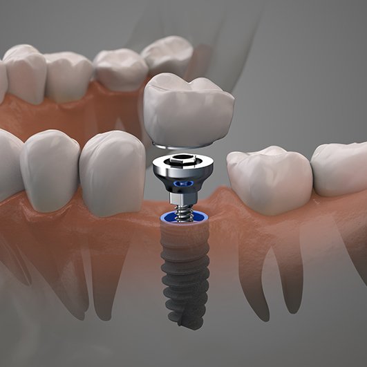 Animated dental implant supported dental crown placement