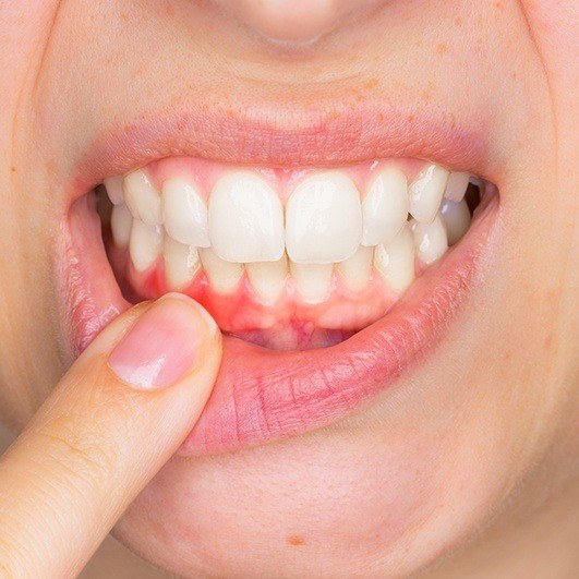 Patient pointing to inflamed gum tissue