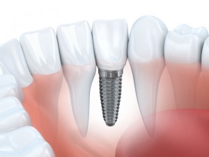 dental implants houston