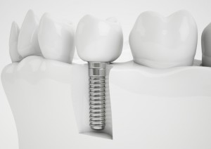 what are dental implants made of